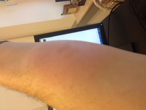 Underarm - ildorm eller koral ?